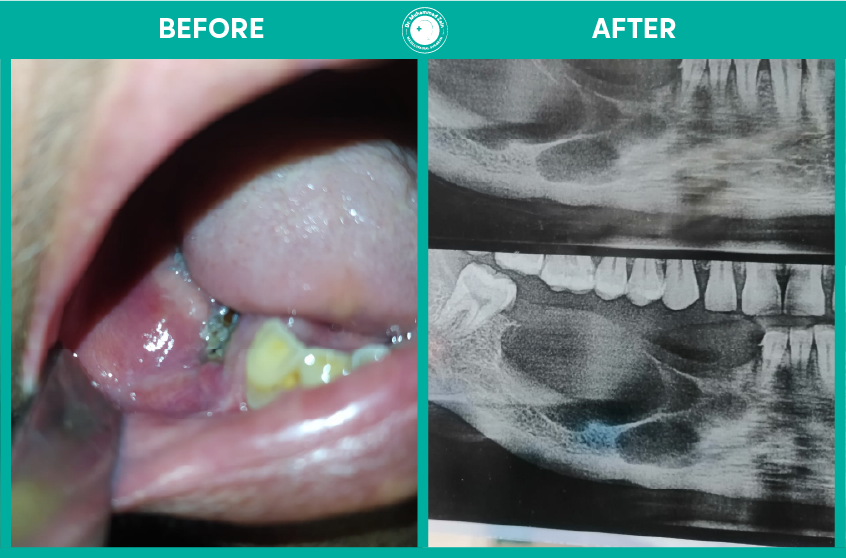 wisdom & impacted teeth extraction