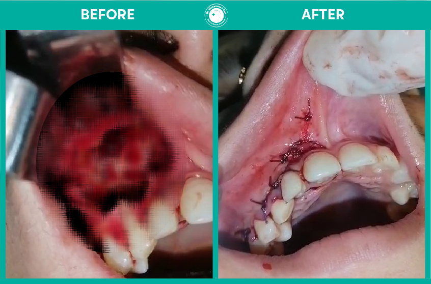 dental implants