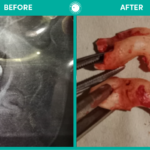 wisdom teeth extraction