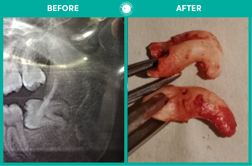 wisdom teeth extraction