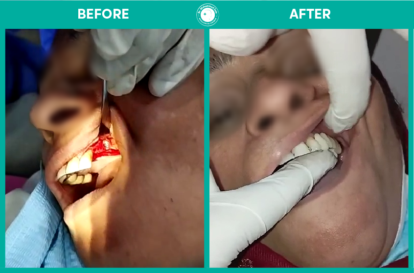 Dental Implants surgery