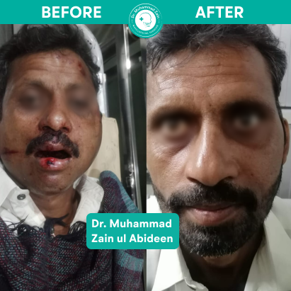 Facial trauma surgery