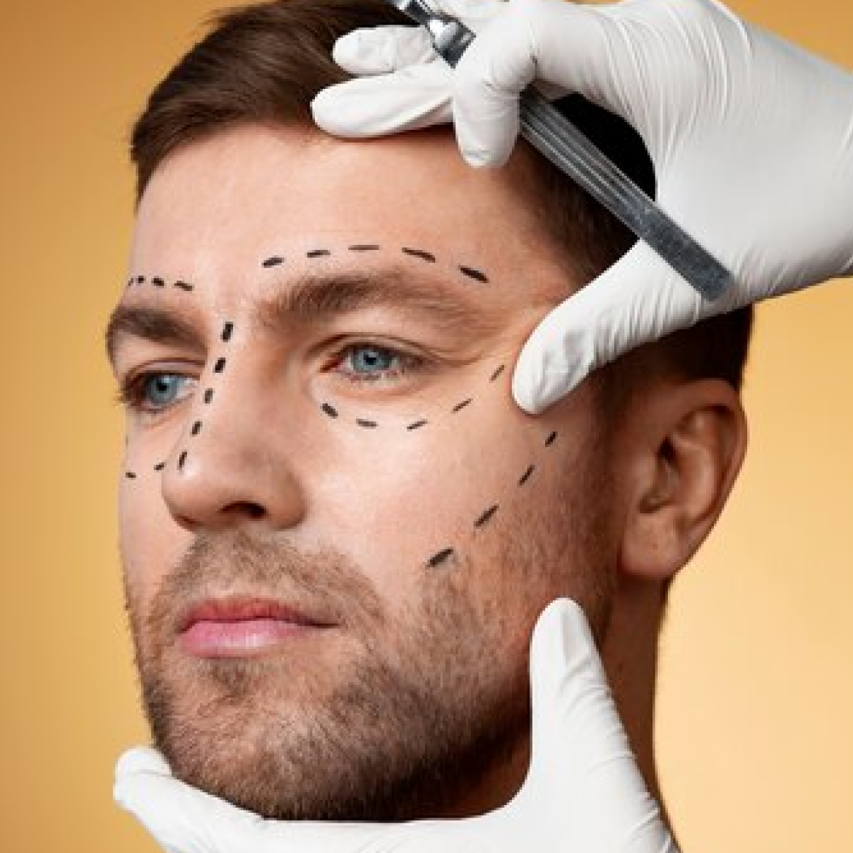 Dimple creation surgery