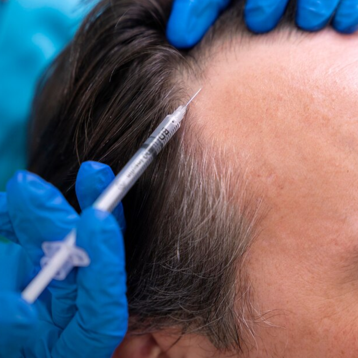 PRP (Platelet-Rich Plasma) therapy for the scalp with exosomes and hair serum growth factors