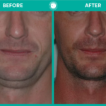 Orthognathic surgery