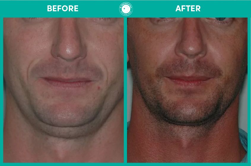 Orthognathic surgery