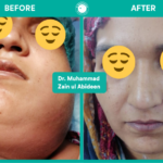 Facial swellings $ Infection surgeries