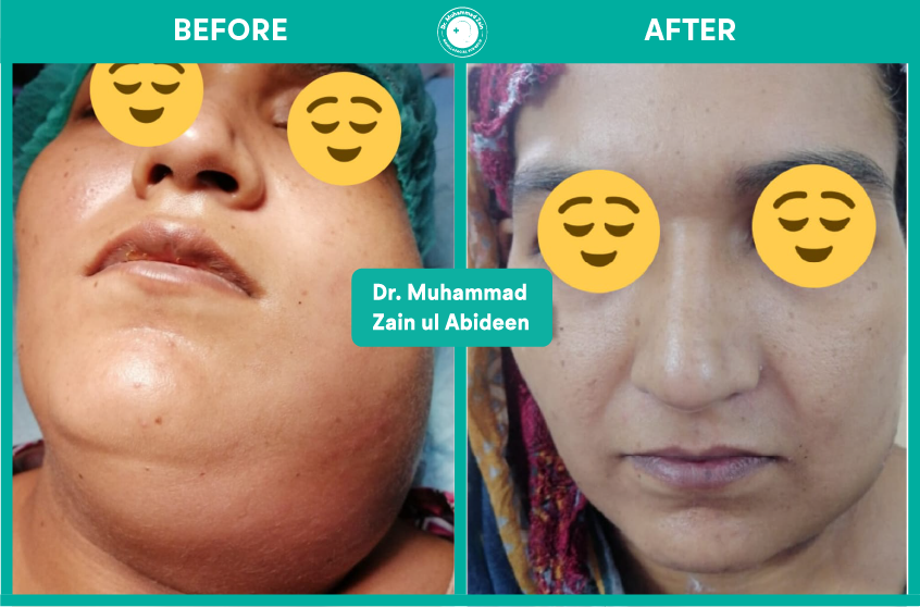 Facial swellings $ Infection surgeries
