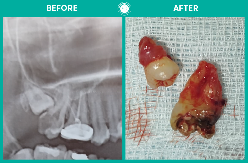 Wisdom teeth extraction