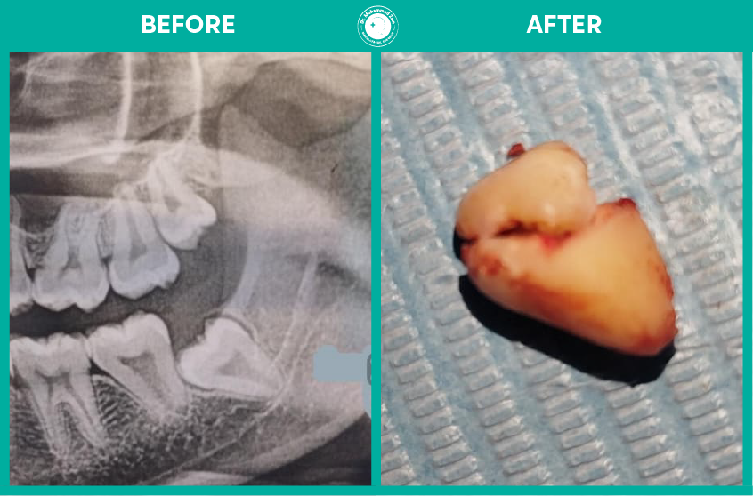 Wisdom teeth extraction