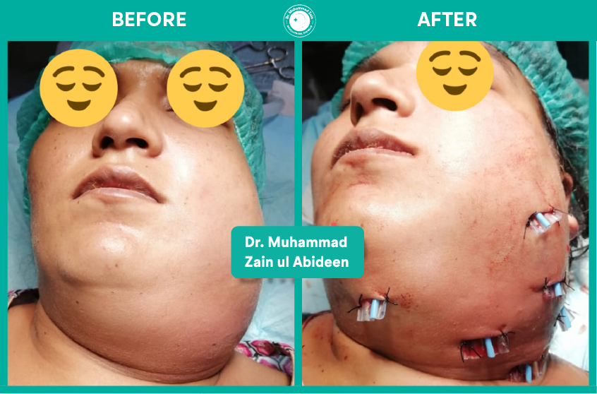 Salivary gland surgeries