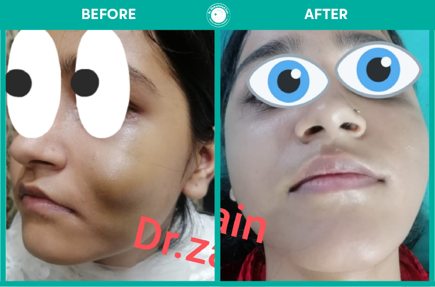 Tumors and cysts of the face and jaws