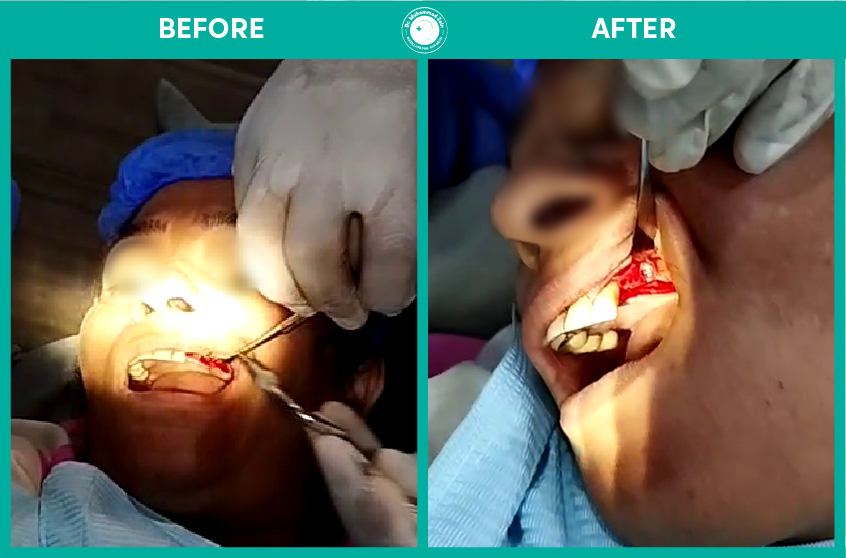 Dental Implants surgery